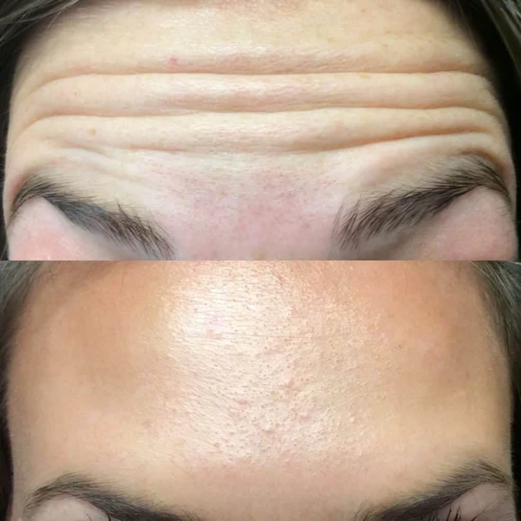 50% DE REMISE TEMPORAIRE | GlowLift™ | Le secret de la beauté intemporelle !