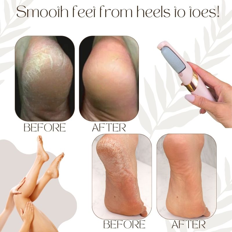 CallusMaster™ - Magicien électrique de callosités | Réduction temporaire de 50%