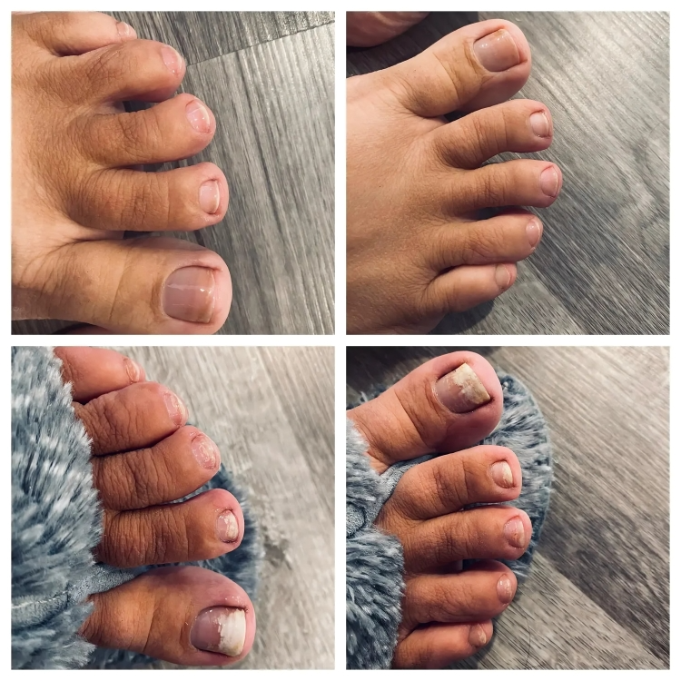 50% DE REMISE TEMPORAIRE | NailRenew™ | Lutter et éliminer les mycoses des ongles !