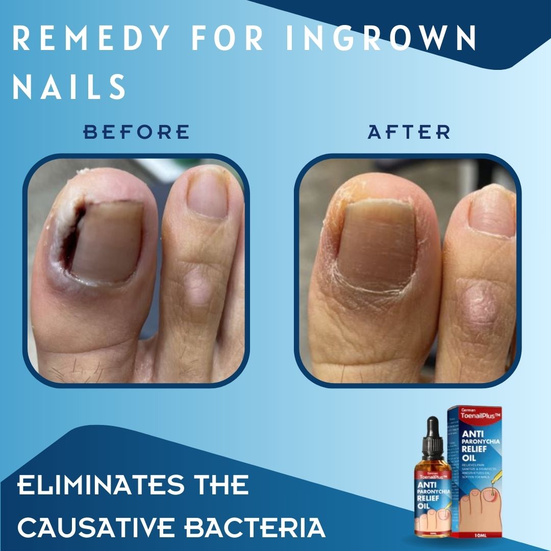 1 + 1 GRATUIT AUJOURD'HUI | ToePerfect™