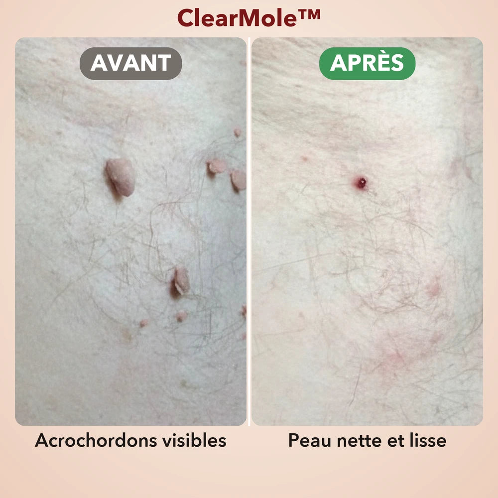 -50 % · OFFRE LIMITÉE · ClearMole™ · Détachant de verrues et d’acrochordons