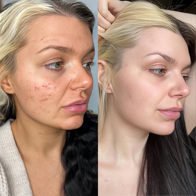 50% DE REMISE TEMPORAIRE | GlowLift™ | Le secret de la beauté intemporelle !