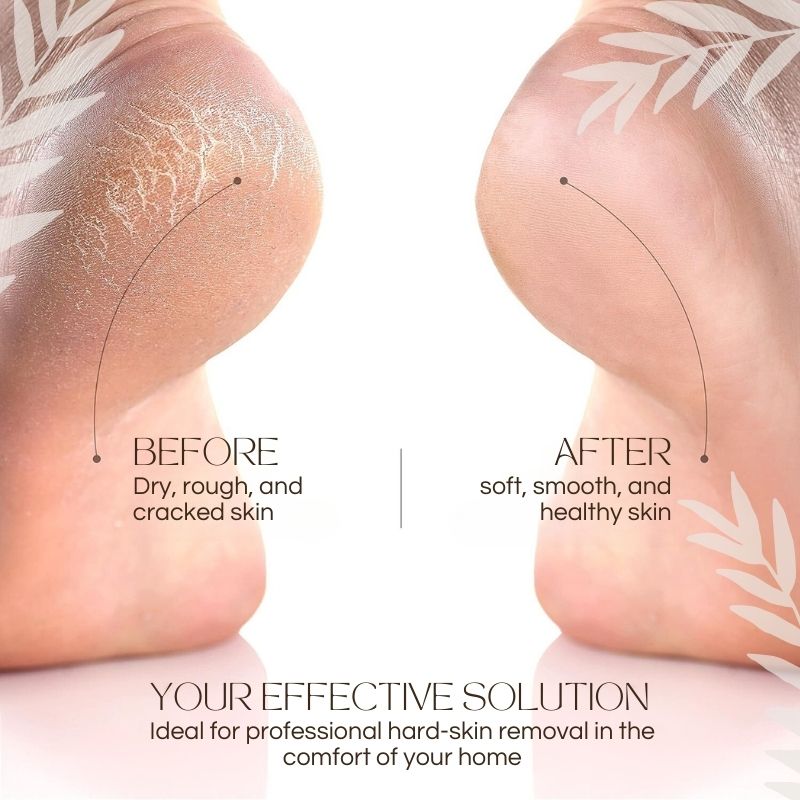 CallusMaster™ - Magicien électrique de callosités | Réduction temporaire de 50%