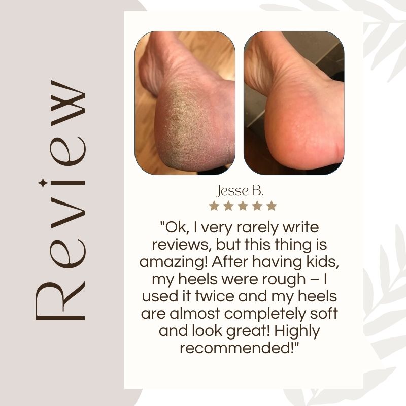 CallusMaster™ - Magicien électrique de callosités | Réduction temporaire de 50%