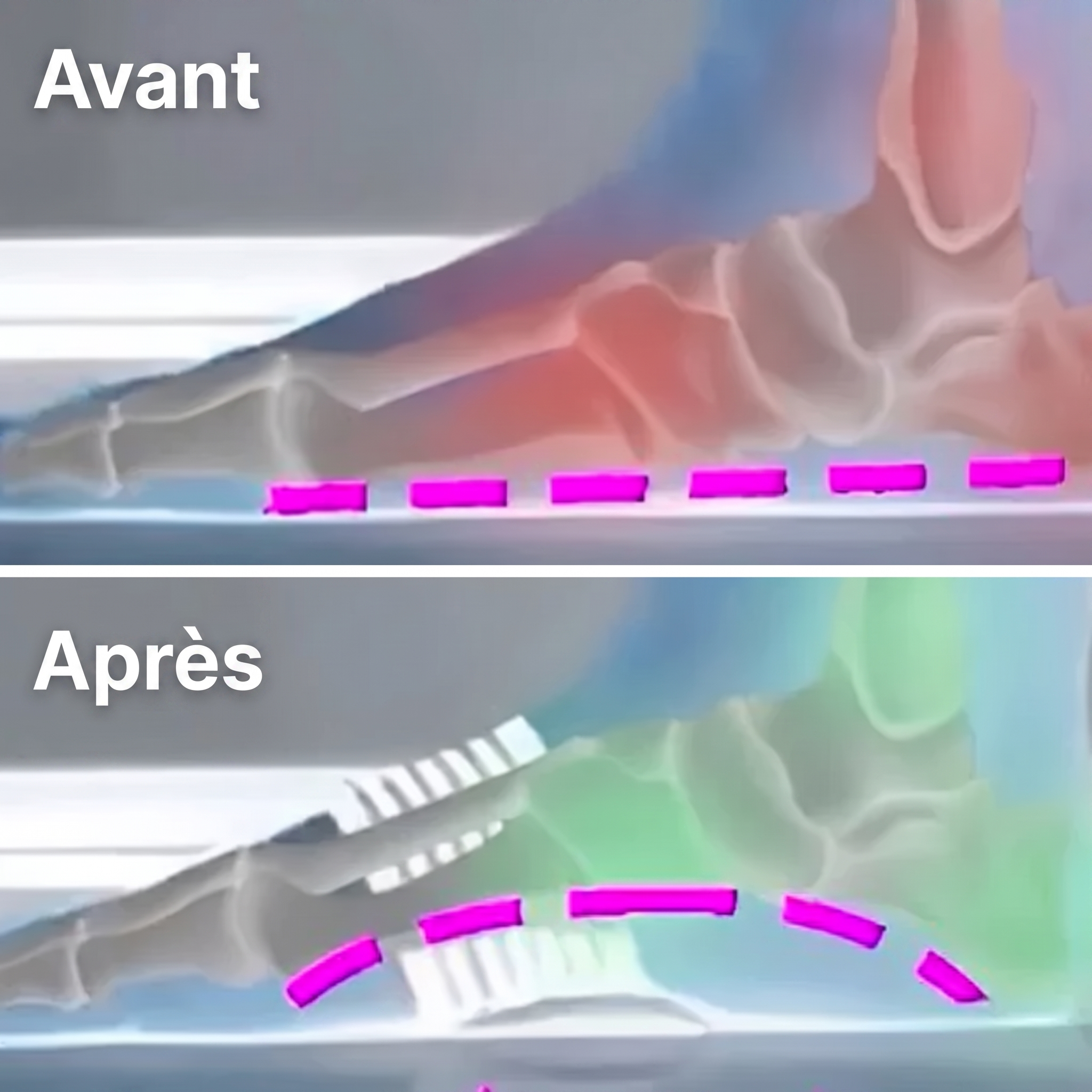 -50 % · OFFRE LIMITÉE · StepRelief™ · Soutien orthopédique de la voûte plantaire