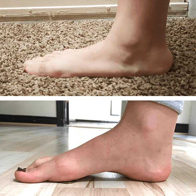 -50 % · OFFRE LIMITÉE · StepRelief™ · Soutien orthopédique de la voûte plantaire