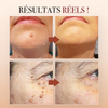 -50 % · OFFRE LIMITÉE · ClearMole™ · Détachant de verrues et d’acrochordons
