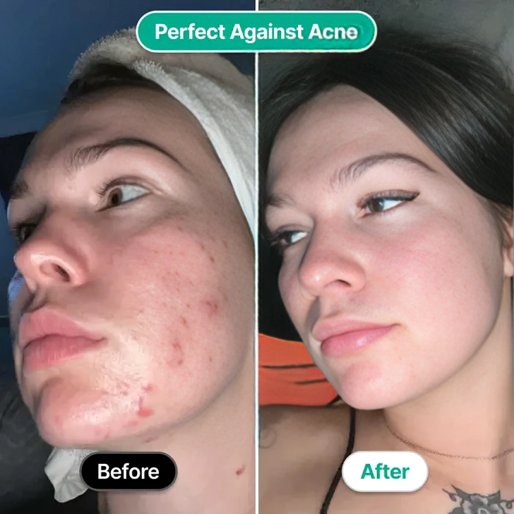 50 % DE REMISE TEMPORAIRE | AcneZap™ | Bâton magique facial à haute fréquence