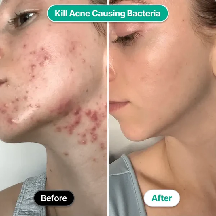 50 % DE REMISE TEMPORAIRE | AcneZap™ | Bâton magique facial à haute fréquence