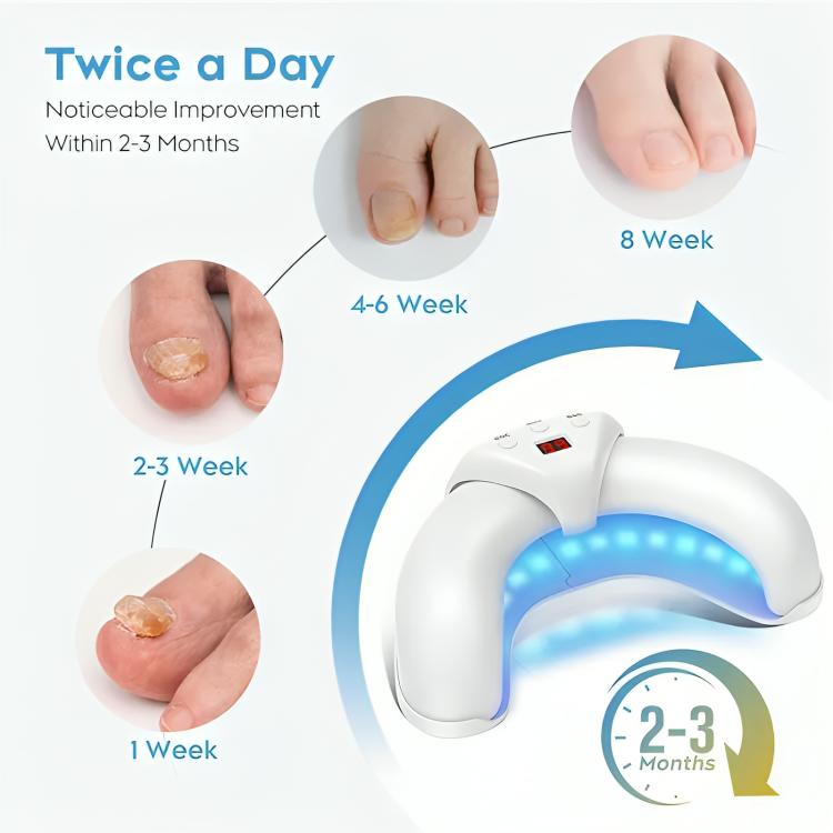 50% DE REMISE TEMPORAIRE | NailRenew™ | Lutter et éliminer les mycoses des ongles !