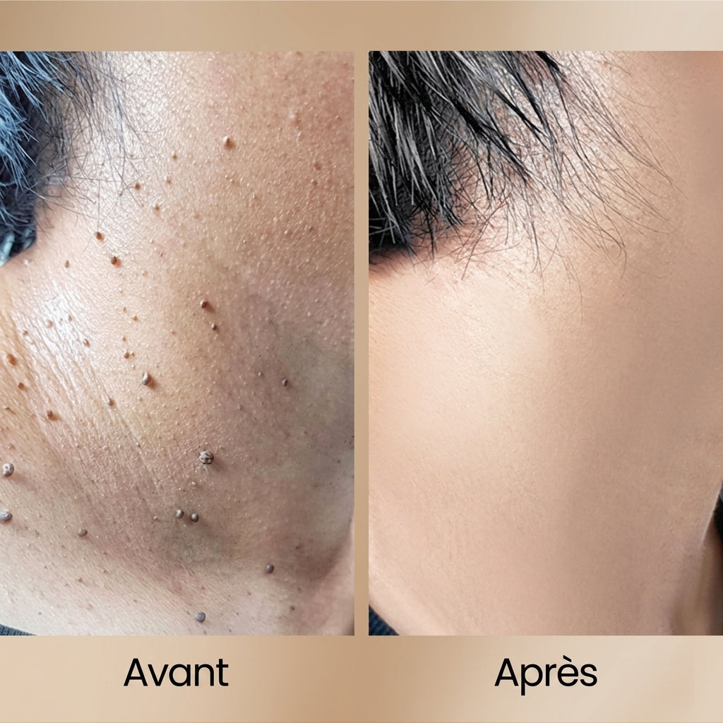 1+1 OFFERT · AUJOURD'HUI · ClearSkin™ · Spray anti-verrues au venin d'abeille