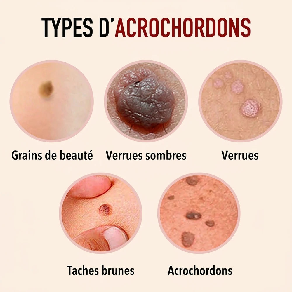 -50 % · OFFRE LIMITÉE · ClearMole™ · Détachant de verrues et d’acrochordons