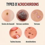 -50 % · OFFRE LIMITÉE · ClearMole™ · Détachant de verrues et d’acrochordons