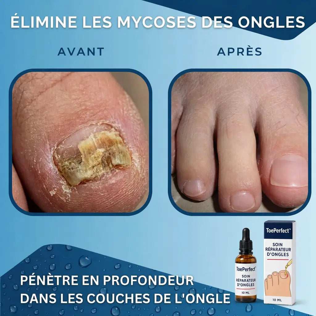 ToePerfect elimine les mycoses des ongles
