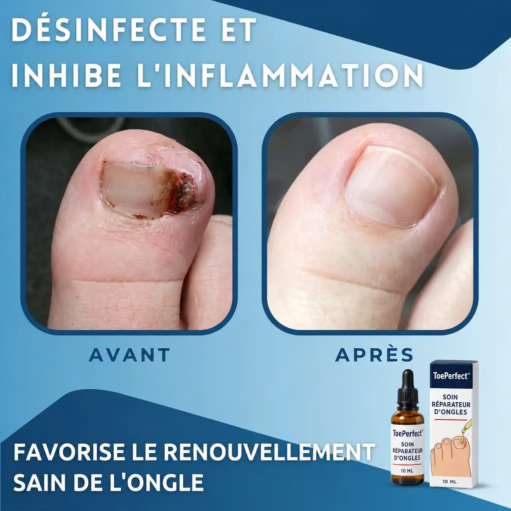 ToePerfect desinfecte et inhibe l'inflammation