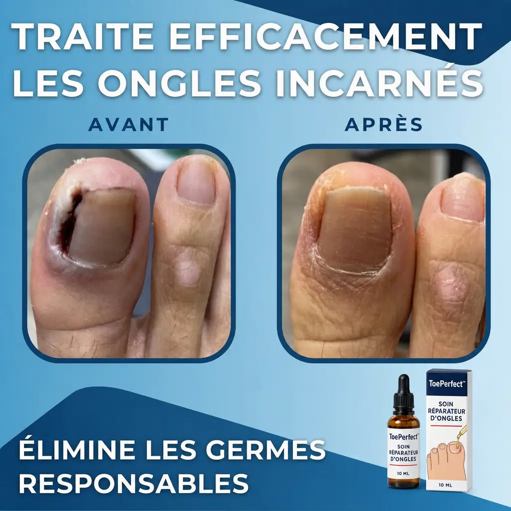 ToePerfect traite les ongles incarnes