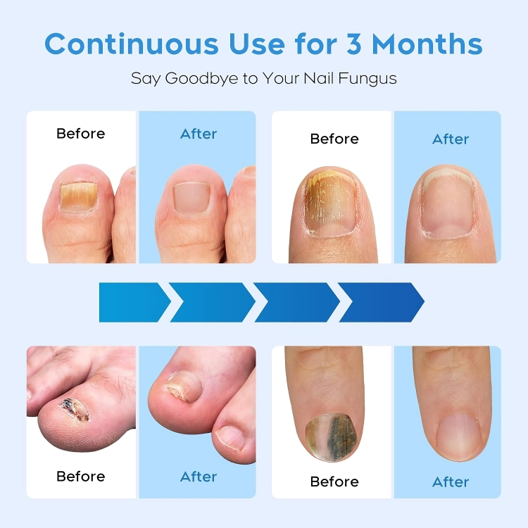 50% DE REMISE TEMPORAIRE | NailRenew™ | Lutter et éliminer les mycoses des ongles !