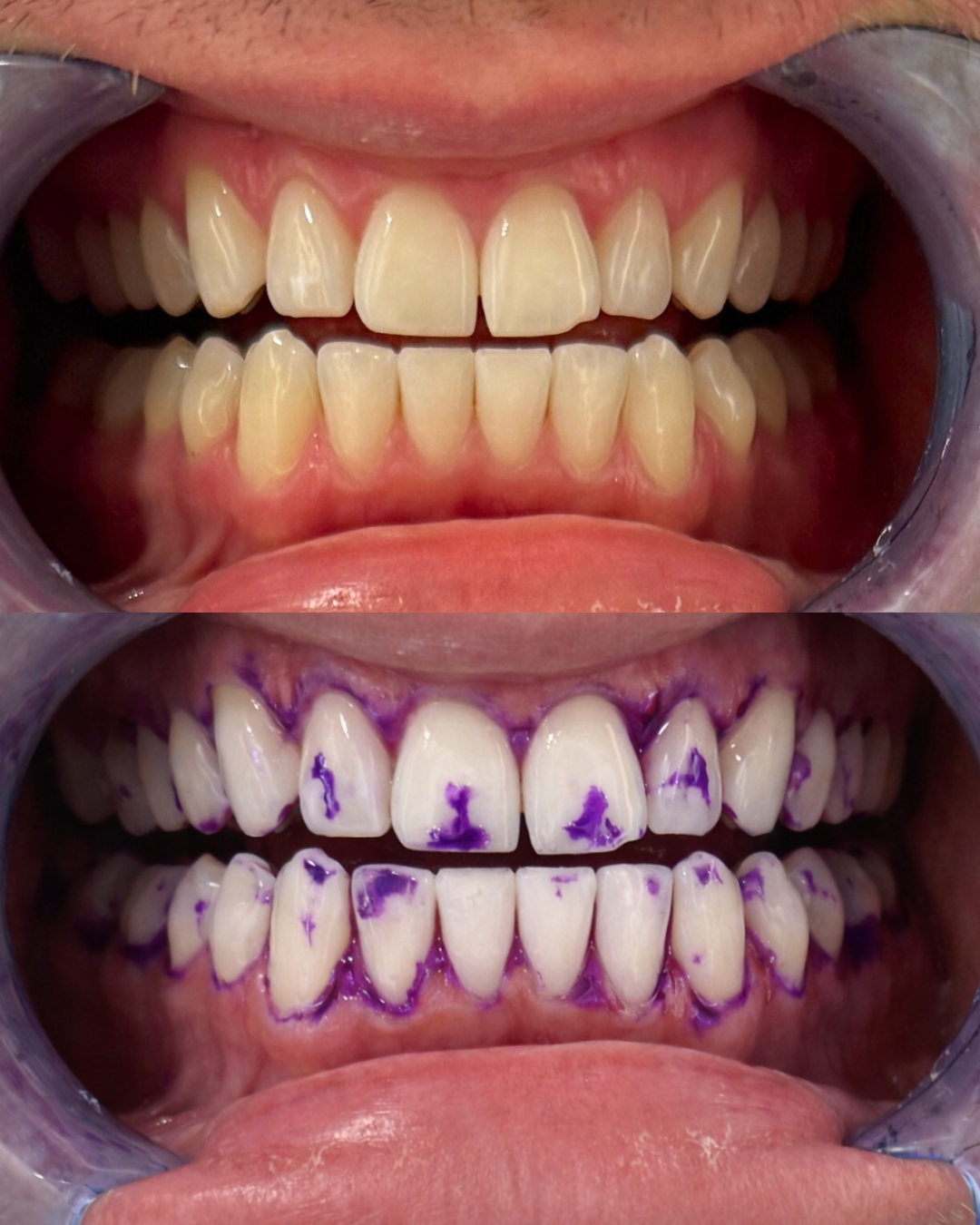 1+1 OFFERT · AUJOURD'HUI · Smilekit · Bandes Blanchissantes Dentaires