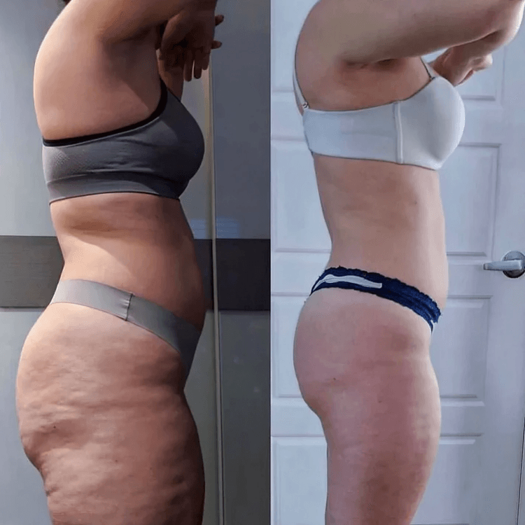 50% RABATT TEMPORÄR | CelluSoothe™ | Elektrisches Anti-Cellulite-Schröpfmassagegerät - MODLIA
